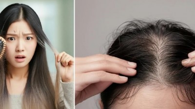 여성형 탈모의 오해와 진실 “갱년기 여성만 탈모 걱정? 20대부터 시작되는 여성형 탈모의 경고”