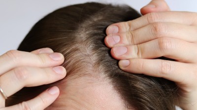 가을, 두피 관리의 계절이 왔다!