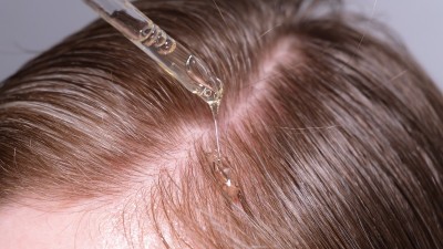 탈모 샴푸 만으론 안돼..., 진화하는 탈모 이코노미