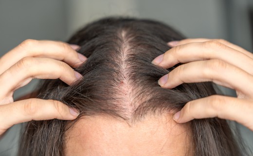 &#034;대학생 10명 중 6명 탈모 걱정&#034;... 20대 두피 시장 급성장