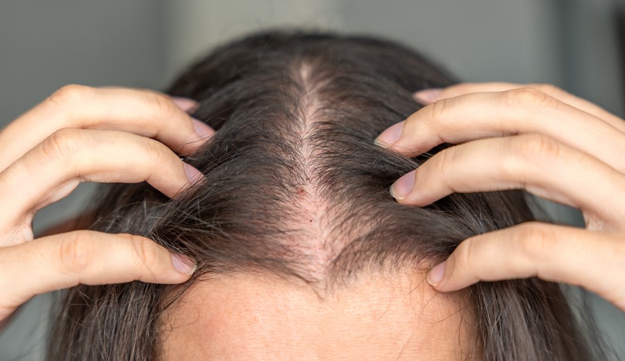 &#034;대학생 10명 중 6명 탈모 걱정&#034;... 20대 두피 시장 급성장