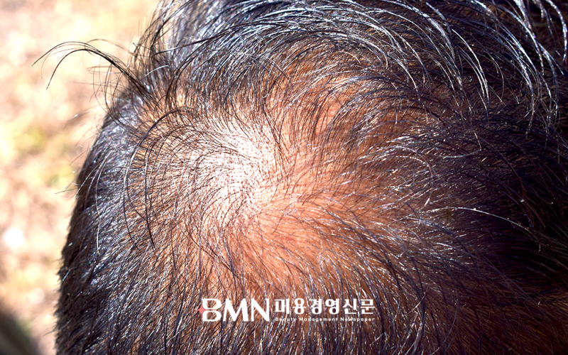 "여름철 습도·땀이 두피 공격한다"... 높은 온도·습도, 피지 분비 급증으로 탈모 위험