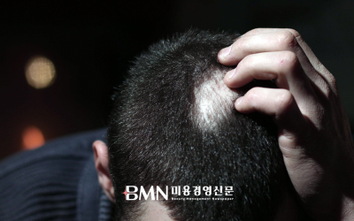 "설마 탈모겠어?" 방심하는 30대 남성... 초기 증상은 이렇게 나타난다